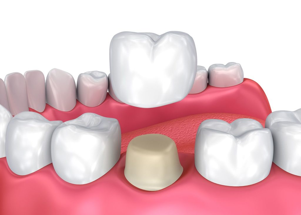 Couronnes dentaires - Soins dentaires - Dentiste D2L